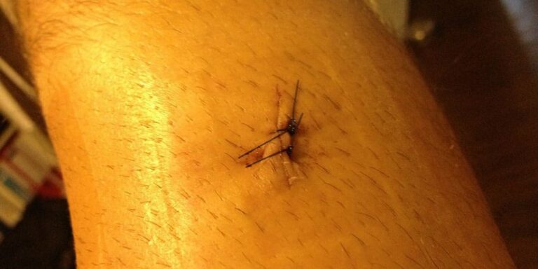 Schienbeinbruch: Wann kannst du endlich wieder laufen?