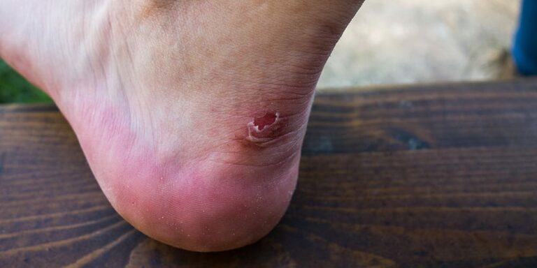Blasen am Fuß: So behandelst du sie richtig
