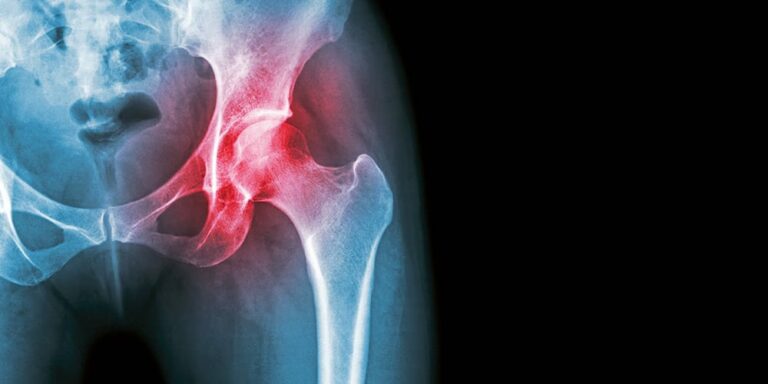 Hüftimpingement: Schmerzhafter Engpass